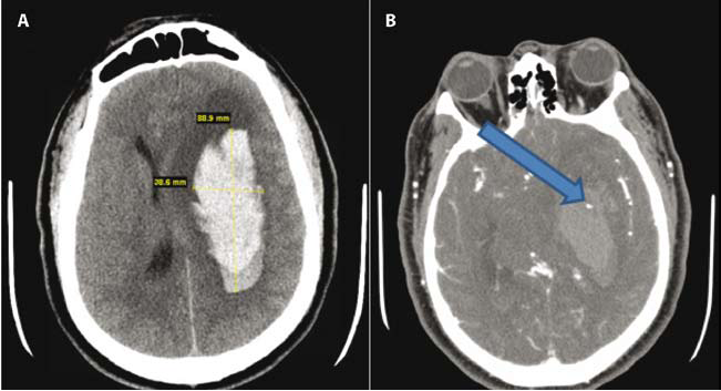 intraserebral kanama