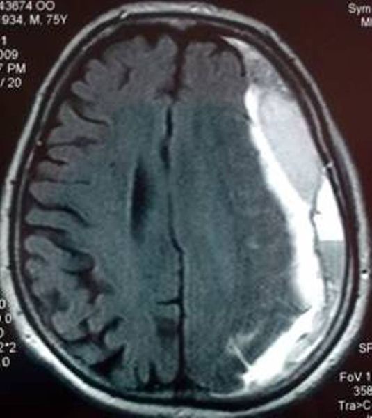Dosya:Kronik subdural hematom 2.jpg
