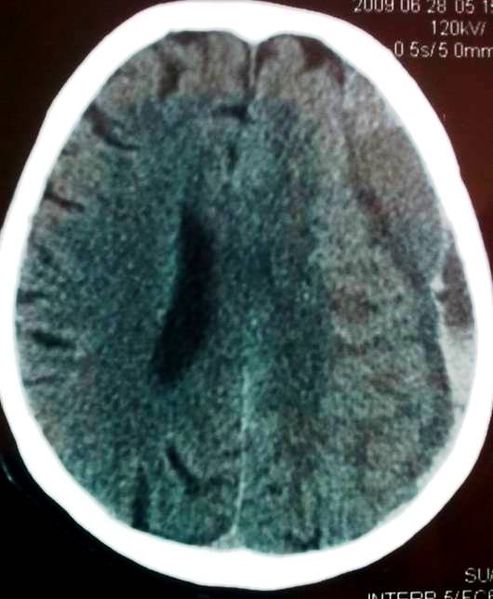 Dosya:Kronik subdural hematom 1.jpg